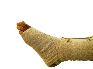 Close-up of trauma-treated ankle with strap and hematoma, isolated.