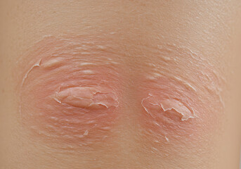 Fototapeta premium Closeup skin irritation on knees
