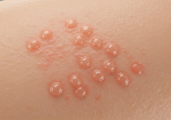 Fototapeta premium Skin rash illustration