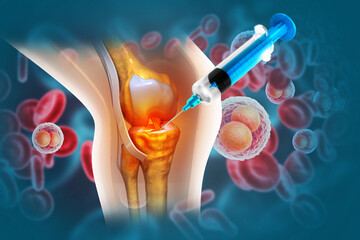 Injection into the knee joint. Platelet Rich Plasma for Knee Osteoarthritis. 3d illustration