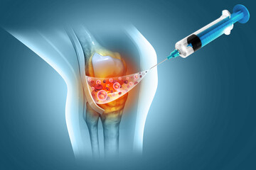 Injection into the knee joint. Platelet Rich Plasma for Knee Osteoarthritis. 3d illustration