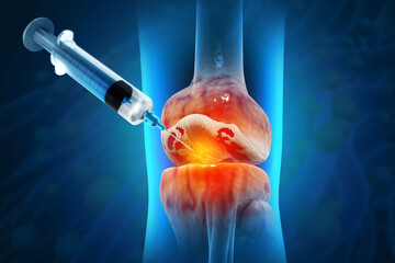 Injection into the knee joint. Drug treatment method for alleviating knee injuries in human. 3d illustration