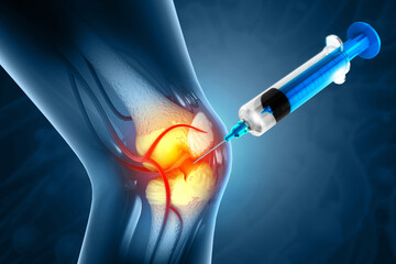 Injection into the knee joint. Drug treatment method for alleviating knee injuries in human. 3d illustration