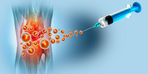 Injection into the knee joint. Platelet Rich Plasma for Knee Osteoarthritis. 3d illustration