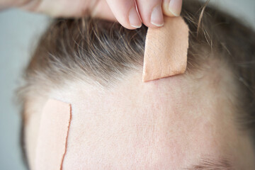 Caucasian female applying healing bandage on forehead wound for skin care and injury recovery.