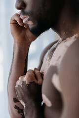 Cropped view of shirtless african american man with vitiligo standing at home