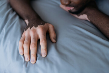 Cropped view of african american man with vitiligo lying on bed in morning