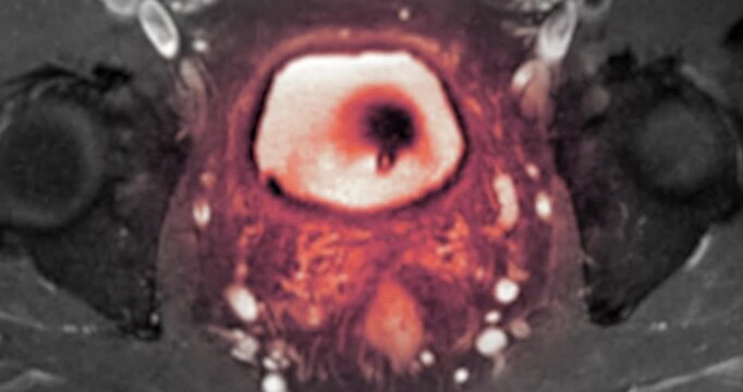 MRI scan reveals an enlarged prostate gland, a possible indicator of prostate cancer. Explore the critical signs and how MRI can assist in early detection.