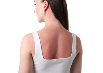 Woman with sunburned skin on white background