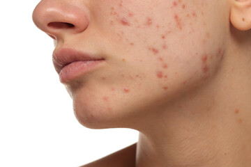 Studio closeup of young woman with acne on cheek and jawline, skincare concept, white background.