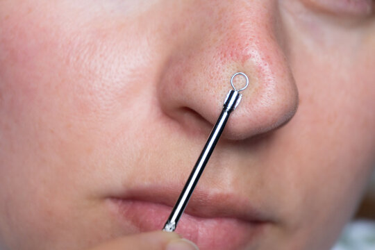 Macro shot of a woman using a blackhead removal tool on her nose. Clean skincare routine concept, dermatology and facial pore cleansing theme.