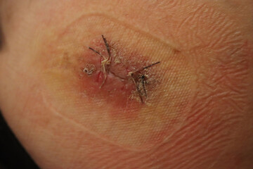 Close-up of skin of elderly man with wound treated with stitches 