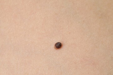 Woman with mole on her body, closeup