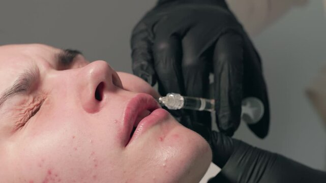 A detailed closeup of a lip injection procedure, highlighting the precise application technique used
