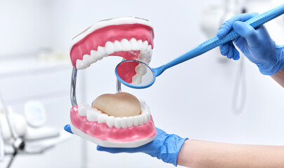 Dental Model Demonstration with Mirror Tool in Clinic