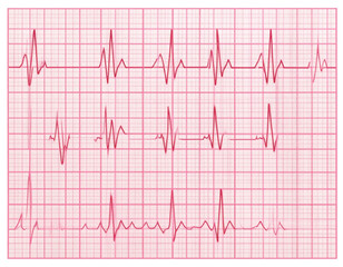 ECG Heartbeat Tracing on Graph Paper with Regular Sinus Rhythm, Isolated on Transparent Background PNG