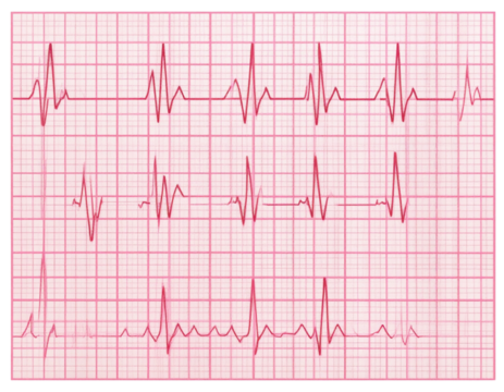 ECG Heartbeat Tracing on Graph Paper with Regular Sinus Rhythm, Isolated on Transparent Background PNG