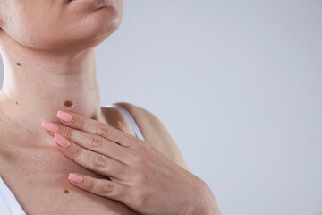Woman with moles on her body against light background, closeup. Space for text