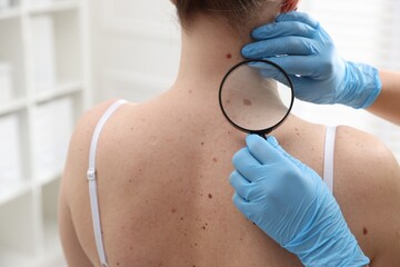 Doctor examining woman's moles in hospital, closeup