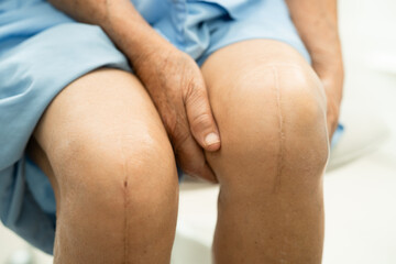 Asian elderly woman patient show her scars surgical total knee joint replacement Suture wound...