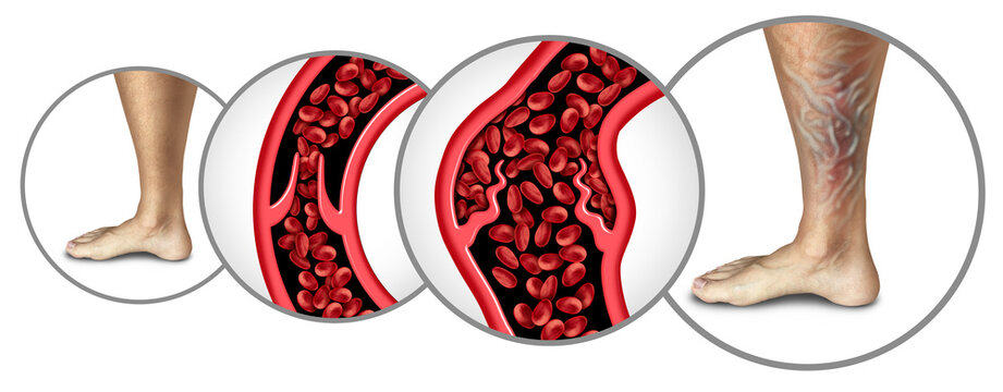 Chronic venous insufficiency as a medical condition with weakened vein valves in the legs impair blood flow back to the heart causing swelling pain and varicose veins.