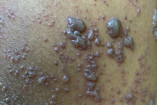Close up of herpes zoster, shingles at right thigh of a man