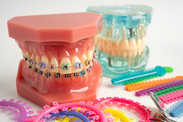 Orthodontic ligatures rings and ties, elastic rubber bands on orthodontic braces, model for dentist...