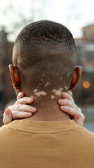 Hands gently holding neck with visible vitiligo spots, symbolizing care and affection