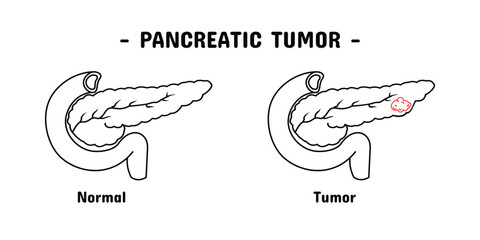 pancreatic tumor set design. medical and health care. Outline style.