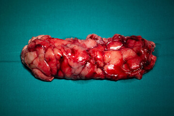 Resected Astrocytoma Brain Tumor Specimen