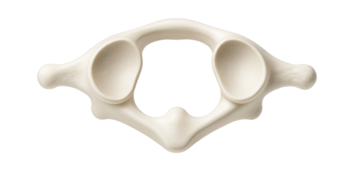 Atlas vertebra with no body and large, concave superior articular facets