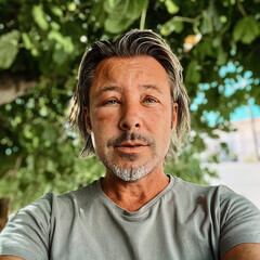 Swollen skin of face of tanned man with blond hair and grey stubble beard. Allergic reaction on...