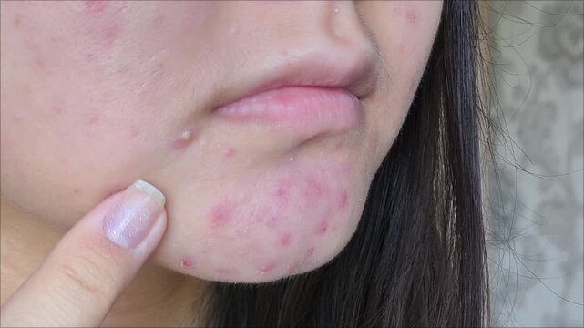 post-acne, scars and red festering pimples on the face of a young woman. concept of skin problems and harmonic failure
