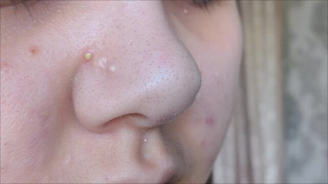 Close-up of woman's nose with blackheads or black dots before and after peeling and cleansing the face isolated on a white background. Acne problem, comedones. Cosmetology dermatology concept