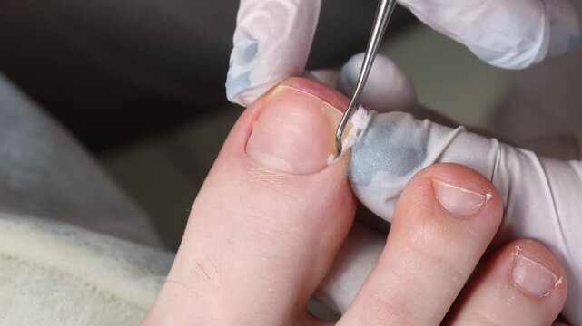 Medical pedicure, podiatrist doing tamponade to a deformed toenail