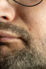 Inflamed pustule developing on unshaven man's face