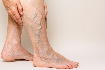 Senior woman gently massaging swollen legs, displaying prominent varicose veins, highlighting physical discomfort and aging related vascular health challenges
