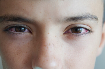 conjunctivitis concept. close up of child with irritated and reddened eyes
