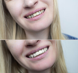 Successful restoration of front incisors. High-quality before and after photos of artistic dental...