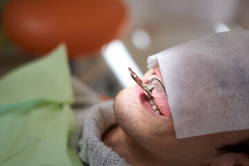 歯の型取りイメージ