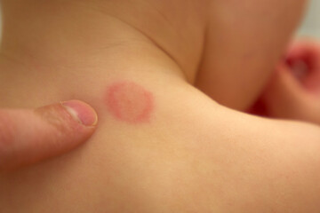 Mosquito bite on child back in a playful indoor setting during daytime