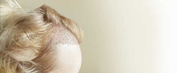 Hair Transplant Surgery.Hair Transplantation and Restoration