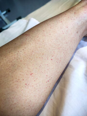 The patient's skin is marked with many small reddish-purple spots known as petechiae, which is an...