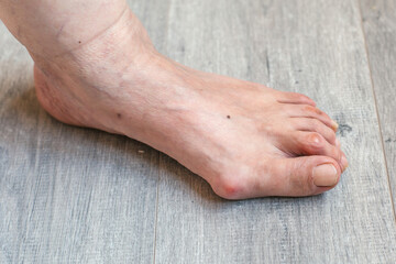 Side view of human foot with hallux valgus and bunion deformity on wooden floor, concept of...