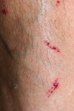 Kratzer und Risswunden am Schienbein