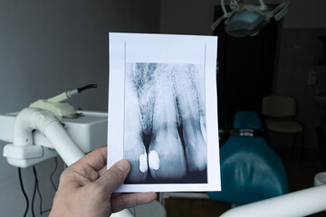 A dentist analyzes a dental X-ray printed on paper.