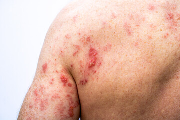 The shingles skin rash located on the back and the back of the arm of an adult male. It is also called zoster or herpes zoster. It is caused by the varicella zoster virus.