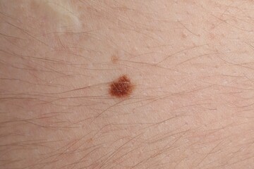 Woman with mole on her body, closeup