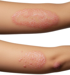 Skin with psoriasis on arms showing scaling and redness concept of health on transparent background  