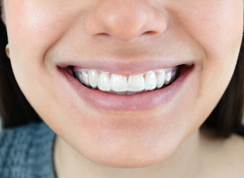 Tratamiento est&eacute;tico para dientes amarillos. Blanqueamiento dental con f&eacute;rula o cubeta. 